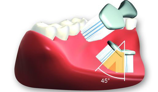 Zähneputzen mit richtiger Zahnputztechnik