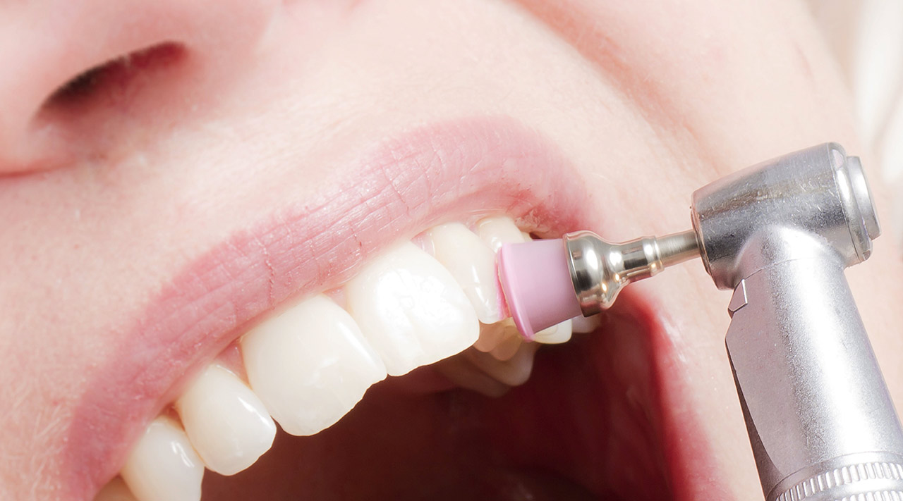 Zahnreinigung - Behandlung mit Polierpaste