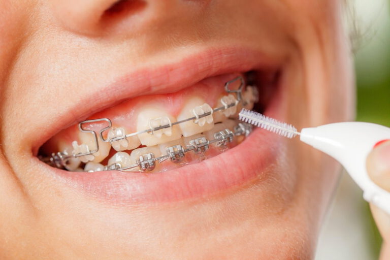 Bracketsreinigen Zahnarztpraxis Dr. Ahlvers & Ahlvers